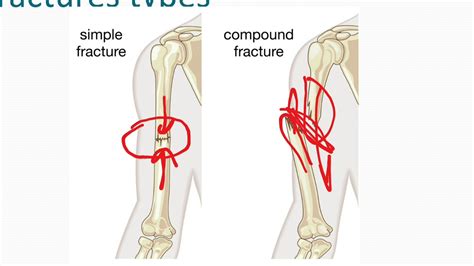 Fracture And Dislocation ( Trauma and Rehabilitation) - YouTube