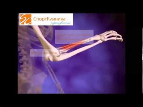 Локоть Теннисиста или латеральный эпикондилит - YouTube