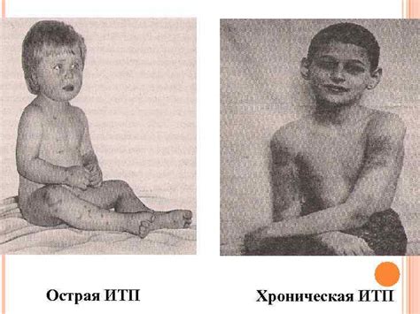 Болезнь Верльгофа Болезнь Верльгофа хроническая иммунопатологическая ...