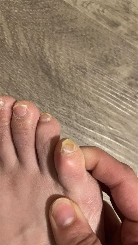 is this nail fungus on my pinky toe? i’ve never seen anything like this
