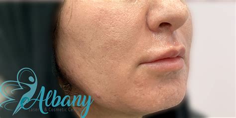Vampire Facial: Case No. 1363 Albany Cosmetic and Laser Centre Edmonton
