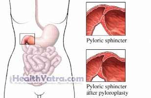 Best Cost Pyloroplasty Adult Surgery, Treatment Hospital in India