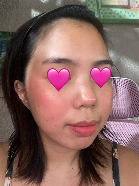 1 year on low dose isotretinoin (10mg/day) : r/Accutane