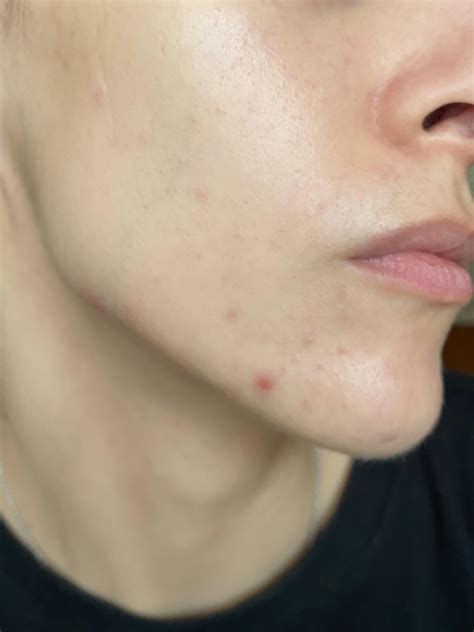 Celiac disease - effect on skin : r/SkincareAddicts