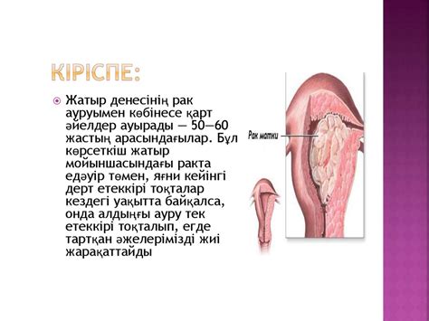 Жатыр денесінің рагы - презентация онлайн