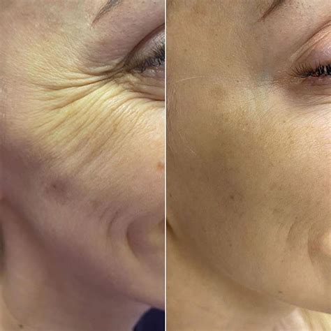 Врач-косметолог в Москве | Botox, Face care wrinkles, Under eye wrinkles