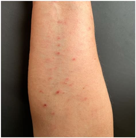 Vasculitis Of The Skin Pictures Cutaneous Vasculitis Overview For