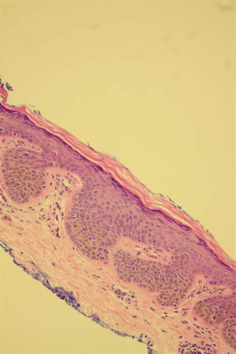 Dermoscopy Atlas | Diagnosis Detail