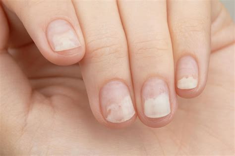 Unghie con onicolisi dopo la rimozione di gel polish per le mani delle ...