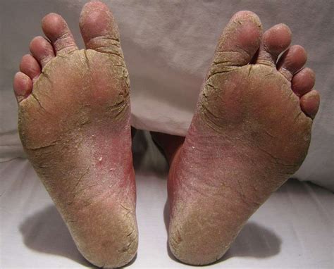 What Is A Foot Callus at Juanita Nystrom blog