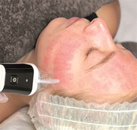 micro needling riverside skin laser clinic