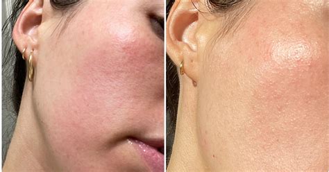 Contact Dermatitis Face Treatment