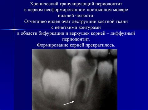 Хронический гранулирующий периодонтит. Особенности клинического течения ...