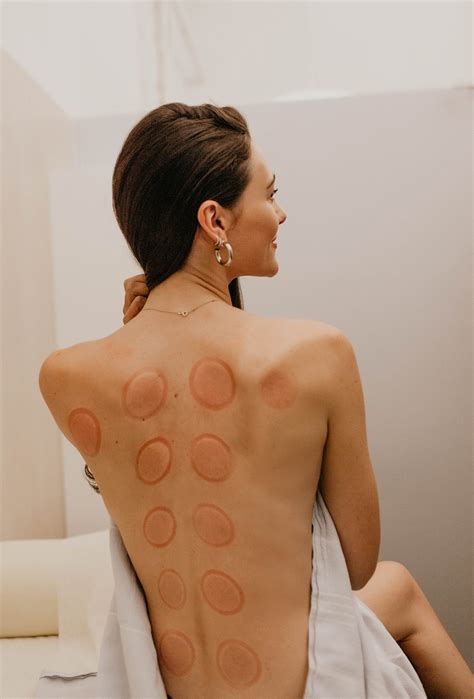 Cupping Therapy Costs: What to Expect – WTHN
