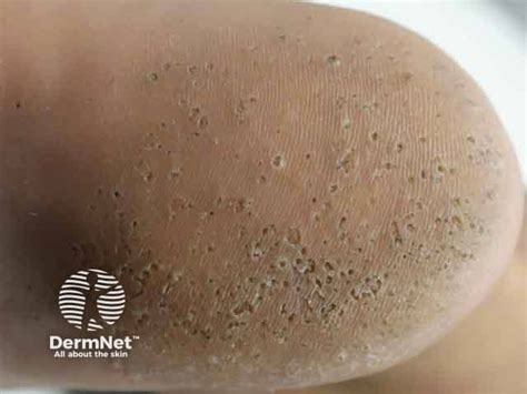 dermnet nz dermnet atdermnetnz