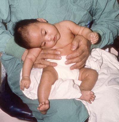 Clinical Overview of Infant Botulism | Botulism | CDC