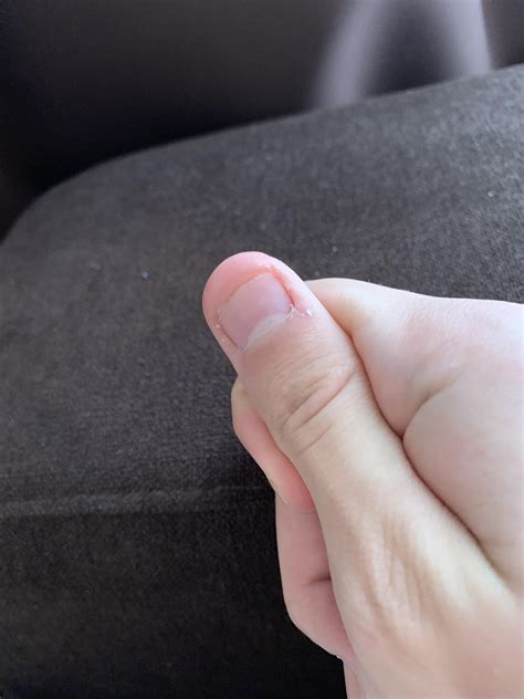 Will my fingernail grow back to its full size? Or will it stay like