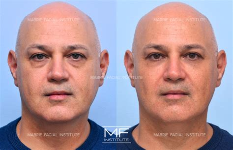 bags under eyes operation 7