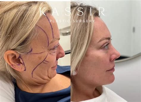 discover  mini facelift cost      kassir