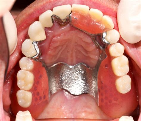 Dentures: Full and Partial, False Teeth Options & Costs UK