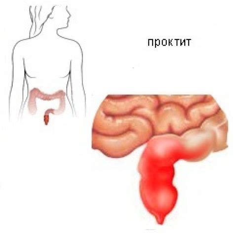 Симптомы и лечение проктита, методы диагностики и профилактики.