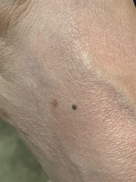 Tiny black dot appeared on top of my foot this summer. Concerns? 51F