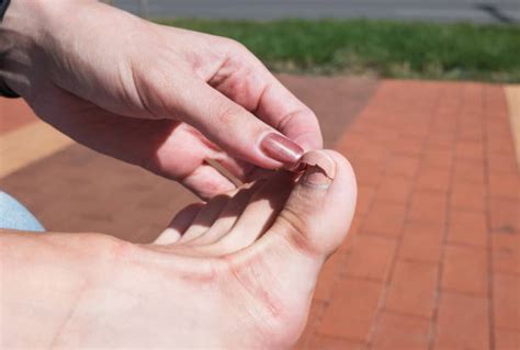 630+ Manchas Blancas En Las Uñas De Los Pies Fotografías de stock ...
