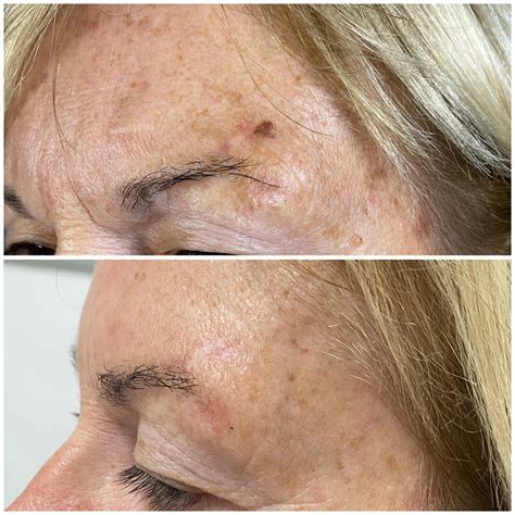 Cryotherapy | Skin Perfection