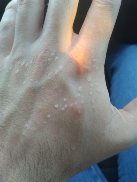Any idea what these weird bumps on my hand are? They're not always this