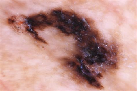 Acral Lentiginous Melanoma | Treatment & Management | Point of Care