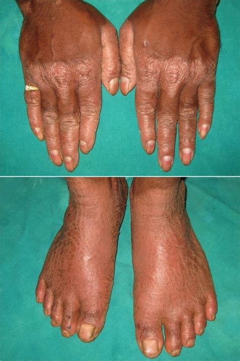 Hyperkeratosis Feet