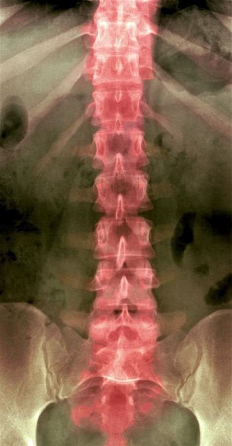 Normal Lumbar Spine, X-ray Photograph by Du Cane Medical Imaging Ltd