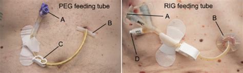 tube feeding   gastrostomy tube canterbury