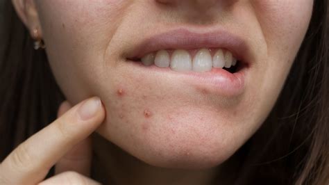 Pimple On Lip