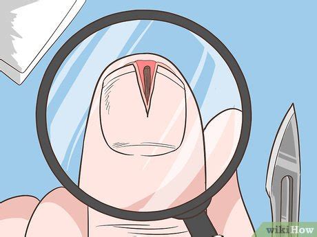 how to get a deep splinter out