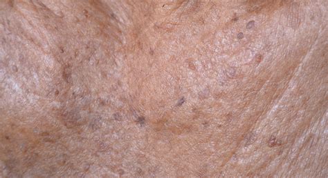 Seborrheic Keratosis – KorPath