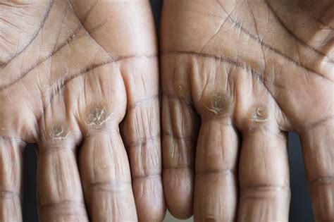 how to get calloused hands