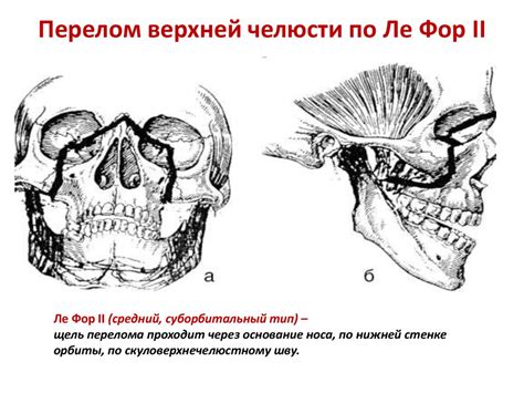 Перелом верхней челюсти. Классификация, клиника, диагностика. Лечение ...
