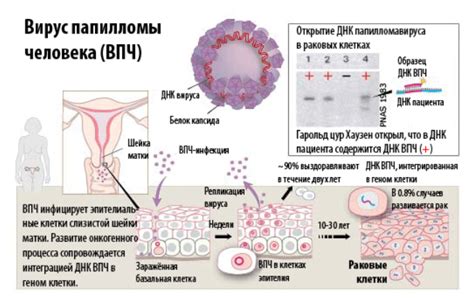 остроконечные кондиломы, вирус папилломы человека | Домашнее лечение ...