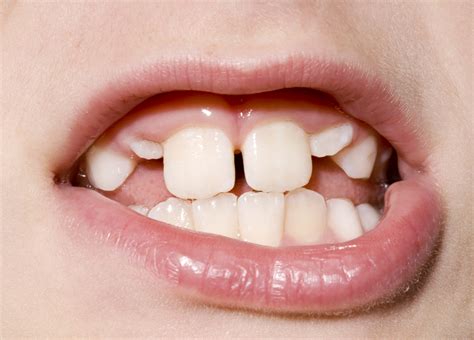 What Every Parent Needs To Know About Permanent Teeth - Viva Smiles ...