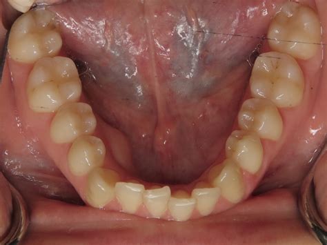 SureSmile Clear Aligner Therapy - Ellis Family Dentistry