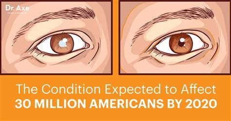 Cataract Symptoms and Natural Cataract Treatments - Dr. Axe