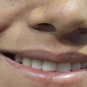 lateral rectus palsy   gaze  scientific diagram