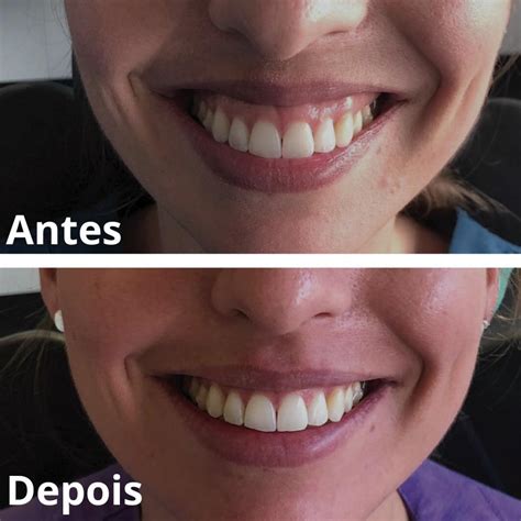 Cirurgia Para Diminuir A Gengiva - Gengivoplastia: Corrija seu Sorriso Gengival em 30 minutos