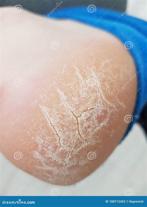 The Heel of Foot with Bad Skin is Covered Stock Photo - Image of dirty