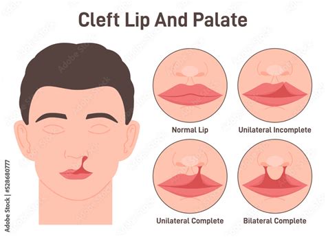cleft lip  cleft palate harelip human face   birth defect