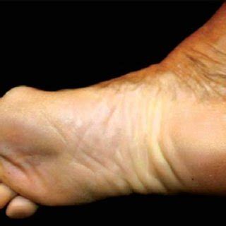 constrictive bands    toe pseudo ainhum