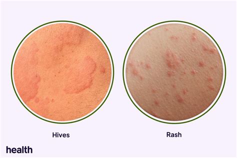 Hives vs. Rash: Similarities and Differences