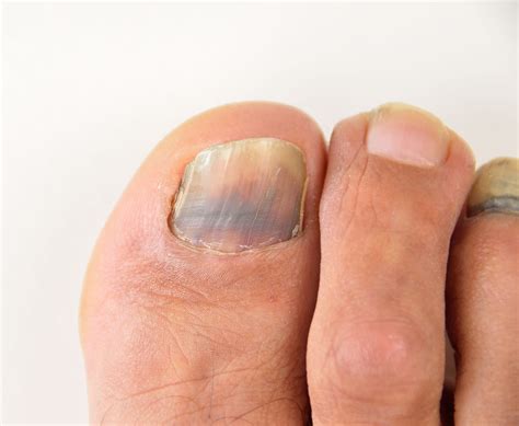 Discoloured Toenails - Atlas Podiatry