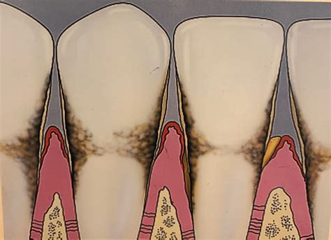 Periodontal (Gum) Disease | Dentist In Reston, VA | Reston Sunrise